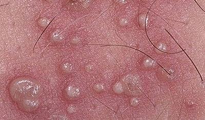 Herpes Pada Penis - Perawatan Untuk Kutil Genital Anda mungkin ingin mempertimbangkan