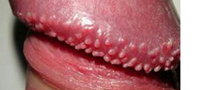 Herpes Pada Penis - Perawatan Untuk Kutil Genital Penyakit ini